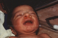 Frothing from nostrils in newborn (Oesophageal atresia)