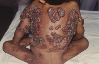Extensive skin lesions over back