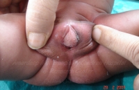 Ambigious genitalia