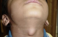 Thyroglossal cyst