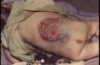 Infected Open neural tube defect
