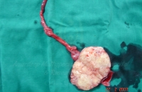 Testicular tumor