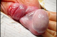 Torsion of testis