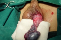 Torsion of testis with gangrene of testis