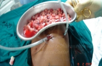 Empyema (peel removed at surgery)