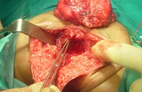 Sacrococcygeal teratoma - after removal