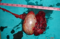 Testicular tumor