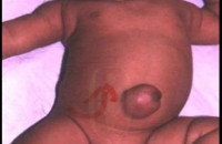 Infra umbilical hernia