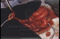 Vitello intestinal duct