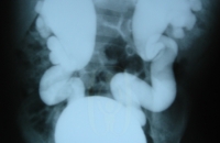 MCU showing bilateral vesicoureteric reflux