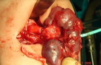 Pelviureteric junction obstruction