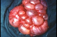 Multicystic kidney