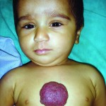 Chest wall hemangioma (4)