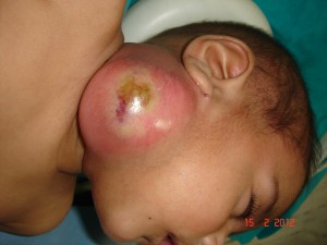 Large abscess (2)