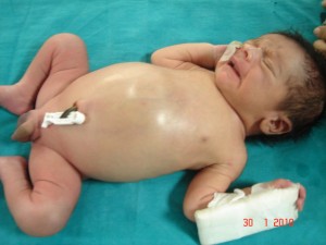 Neonatal HD (2)