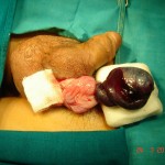 Torsion testis (Same case) (3)