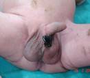 anorectal-malformations-1