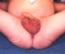 anorectal-malformations-2