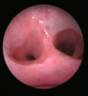 bronchoscopy-1