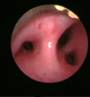 bronchoscopy-2