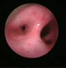 bronchoscopy-3