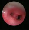 bronchoscopy-4