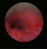 bronchoscopy-5