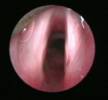 bronchoscopy-7