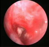 bronchoscopy-8