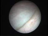 cystoscopy-1