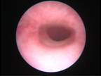 cystoscopy-3