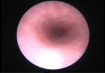 cystoscopy-4