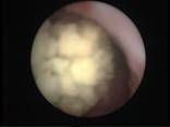 cystoscopy-5