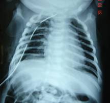 diaphragmatic-hernia-4