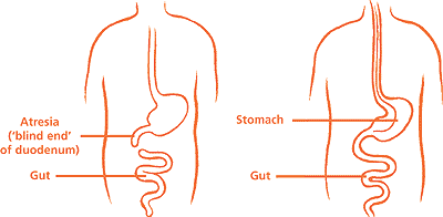 duodenal-atresia-1