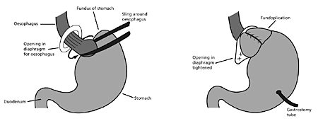 gastroesophageal-reflux-and-fundoplication1