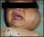 hemangiomas-5