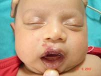 hemangiomas-8