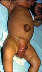 hernia-3