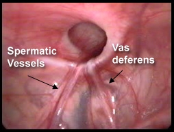 hydrocele-1