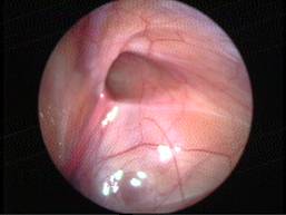 hydrocele-2