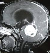 hydrocephalus-2