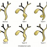 image choledochal cyst