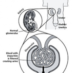 kidney stone