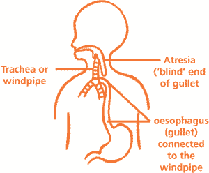 oesophageal-atresia-with-tracheo-oesophageal-fistula-1