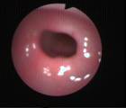 oesophagoscopy-and-gastroscopy-4