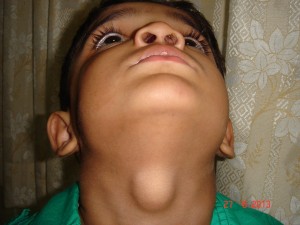 thyroglossal cyst (4)