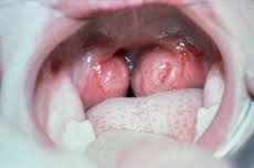 tonsills