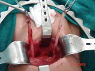 ureteric-re-implantation-1