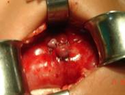 ureteric-re-implantation-2